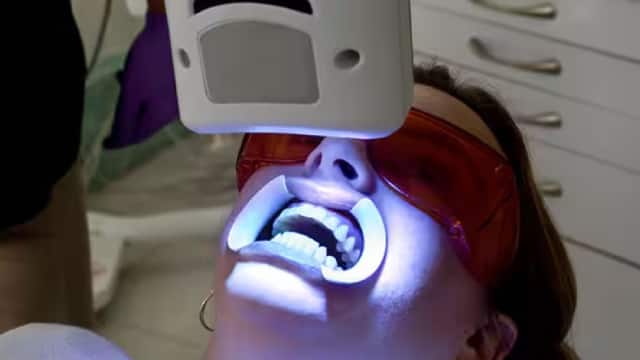 Bělení zubů LED lampou 