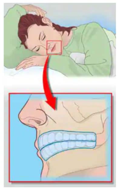 Chránič, který nosíte během spánku, ochrání vaše zuby, ale není to lék.